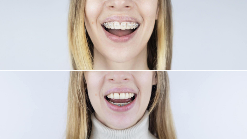 Invisalign Before and After Pictures 2 - Sherman Oaks Smile studio