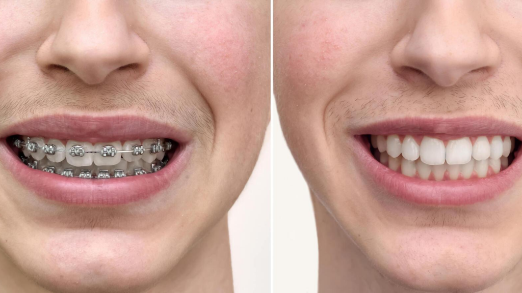 Invisalign Before and After Pictures 1 - Sherman Oaks Smile studio