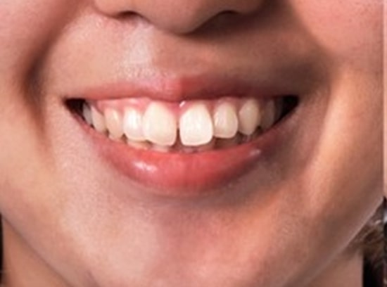 ORTHODONTICSBefore