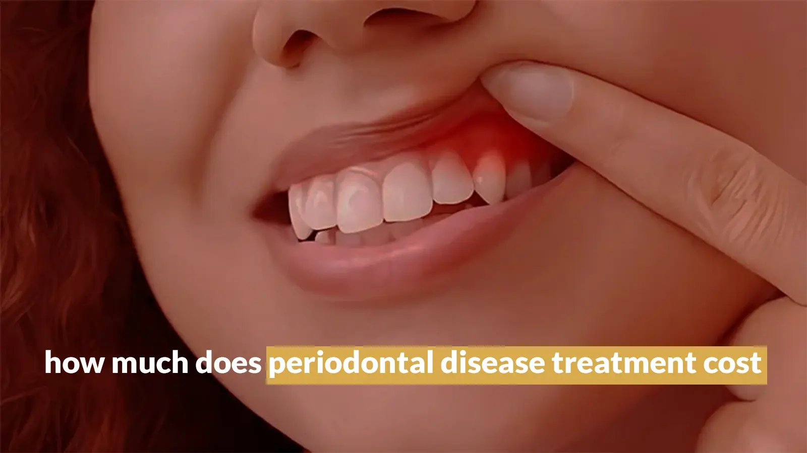 HOW MUCH DOES PERIODONTAL DISEASE TREATMENT COST - Sherman Oak Smile Studio