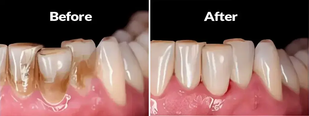 Zirconia Veneers 1