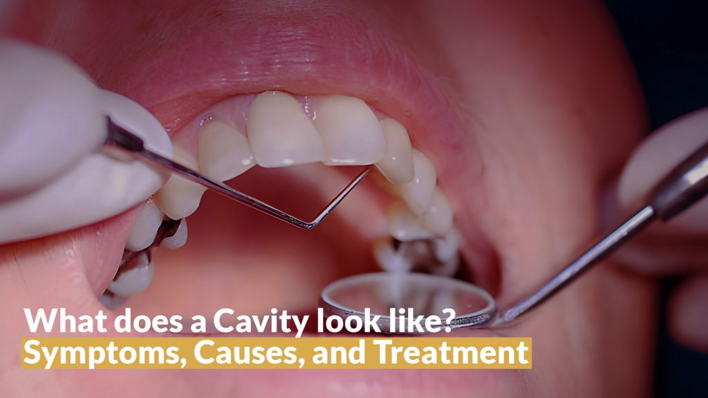 What does a Cavity look like Symptoms, Causes, and Treatment