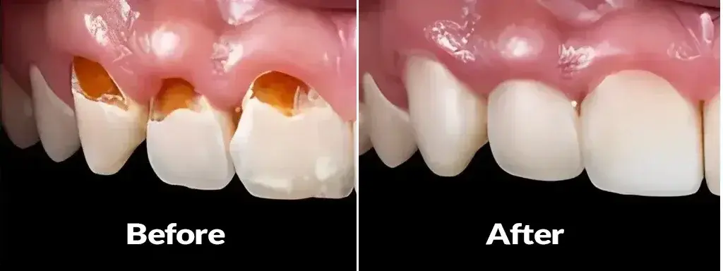composite veneers 1