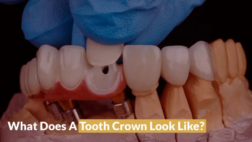 What does a dental crown look like - Types and Benefits