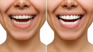 before and after