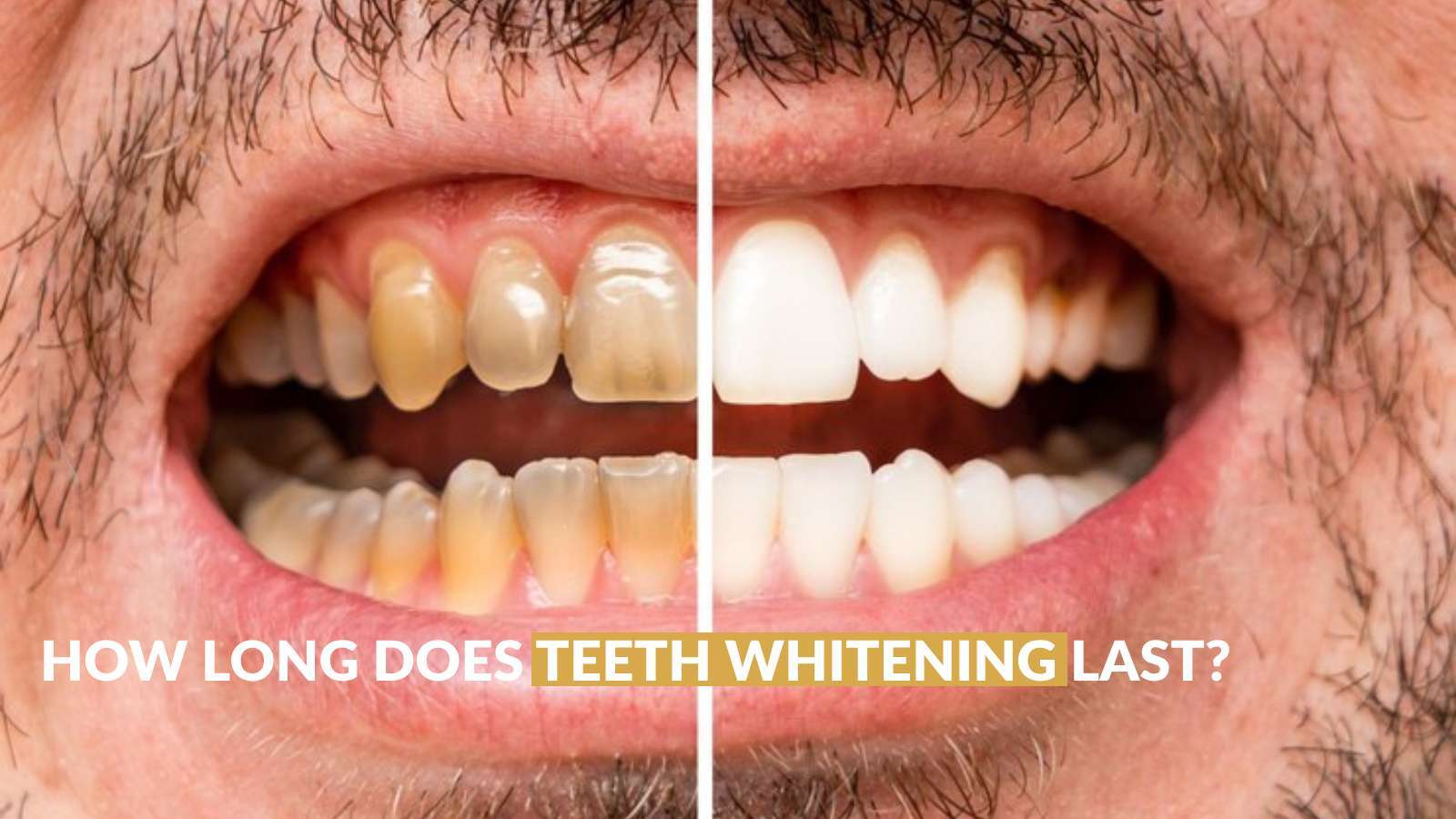 How Long Does Teeth Whitening Last