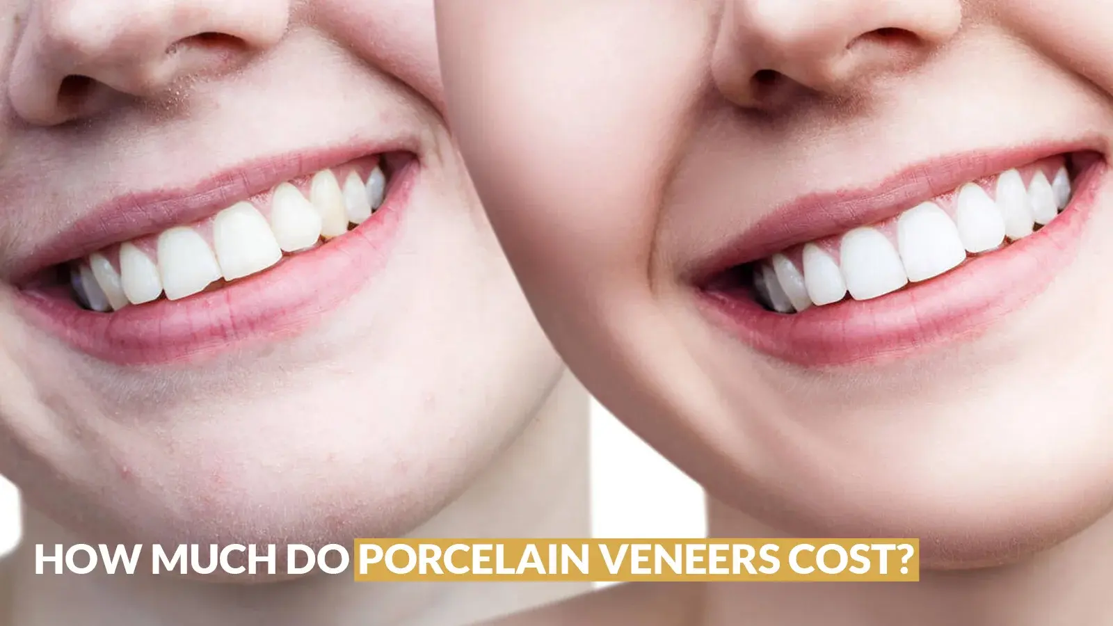 How Much do Porcelain Veneers Cost