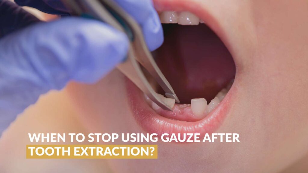 When to Stop Using Gauze After Tooth Extraction