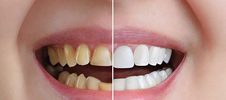 Before And After