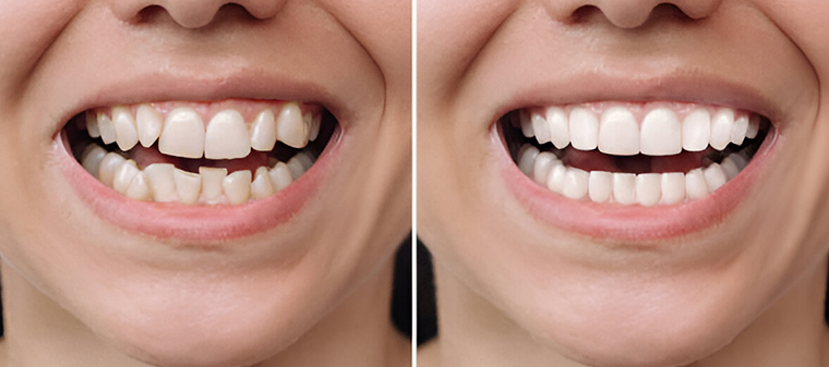 before and after cosmetic dentist