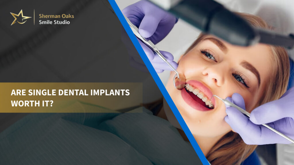 single dental implants