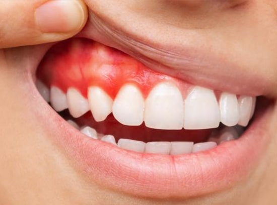 Periodontal Disease Treatment